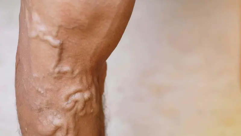 The Hidden Factors Behind Varicose Vein: What You Need to Know